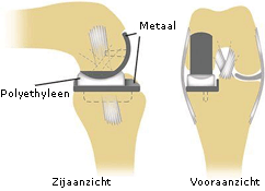 gedeeltelijkeknie