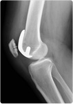 partial_knee_02
